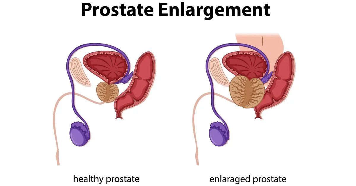 How To Stop Prostate Enlargement