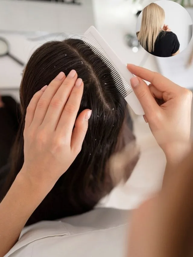 What causes dandruff? Probably not what you think