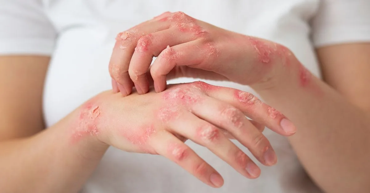 5 Early Signs Of Leprosy